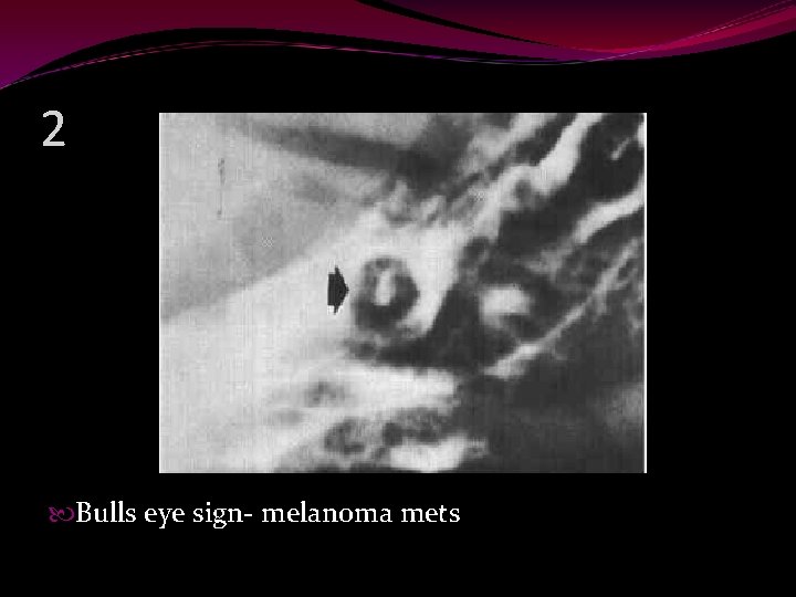 2 Bulls eye sign- melanoma mets 