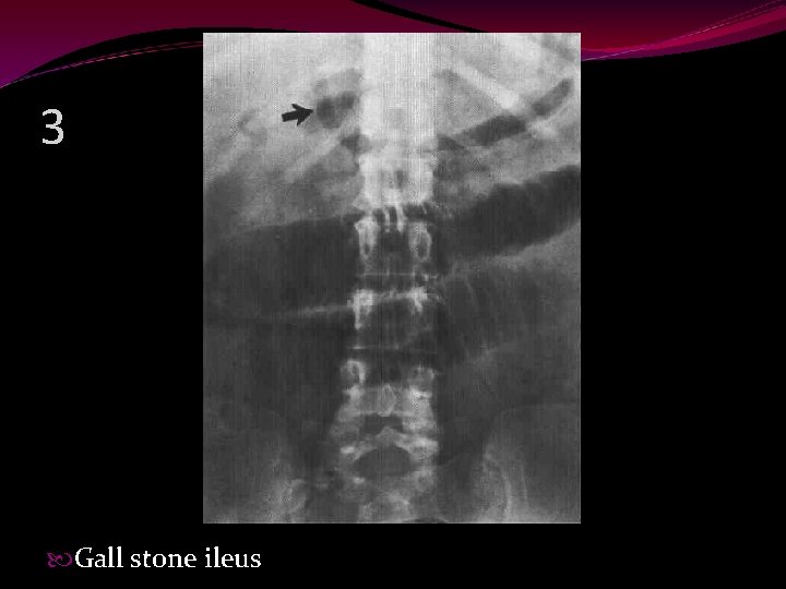 3 Gall stone ileus 