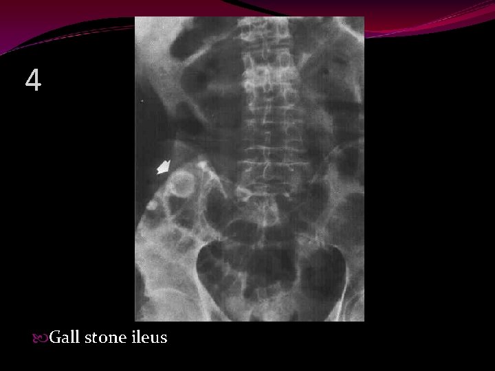 4 Gall stone ileus 
