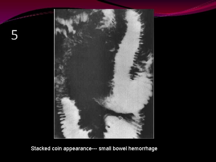5 Stacked coin appearance--- small bowel hemorrhage 