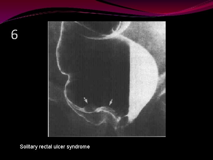 6 Solitary rectal ulcer syndrome 