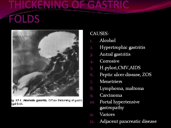 THICKENING OF GASTRIC FOLDS CAUSES 1. Alcohol 2. Hypertrophic gastritis 3. Antral gastritis 4.