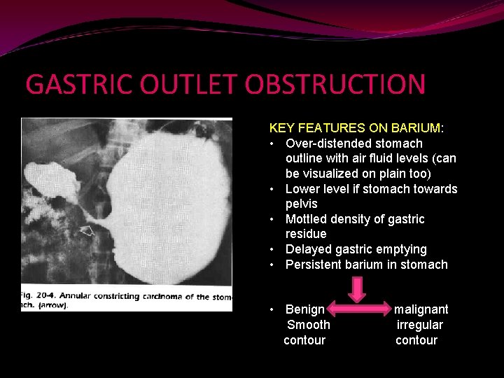 GASTRIC OUTLET OBSTRUCTION KEY FEATURES ON BARIUM: • Over-distended stomach outline with air fluid