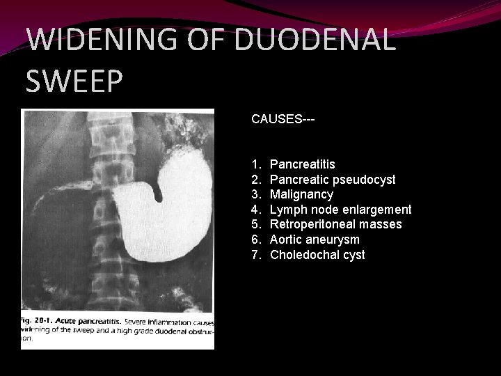 WIDENING OF DUODENAL SWEEP CAUSES--- 1. 2. 3. 4. 5. 6. 7. Pancreatitis Pancreatic