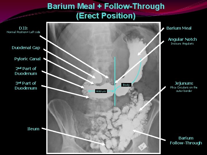 Barium Meal + Follow-Through (Erect Position) DJJ: Barium Meal Normal Position= Left side Angular