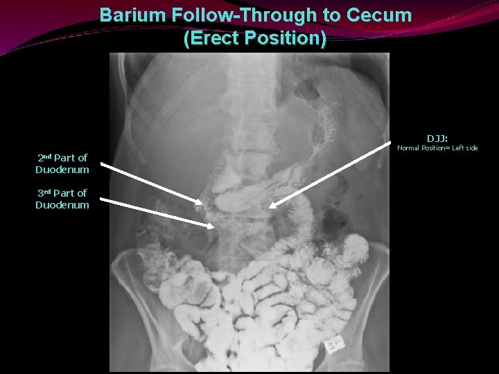Barium Follow-Through to Cecum (Erect Position) DJJ: 2 nd Part of Duodenum 3 rd