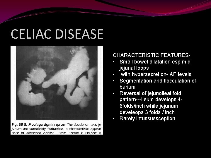 CELIAC DISEASE CHARACTERISTIC FEATURES • Small bowel dilatation esp mid jejunal loops • with