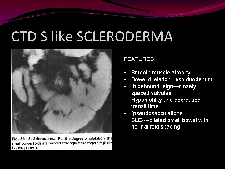 CTD S like SCLERODERMA FEATURES: • Smooth muscle atrophy • Bowel dilatation , esp