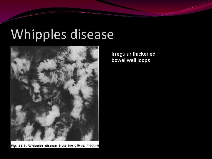 Whipples disease Irregular thickened bowel wall loops 