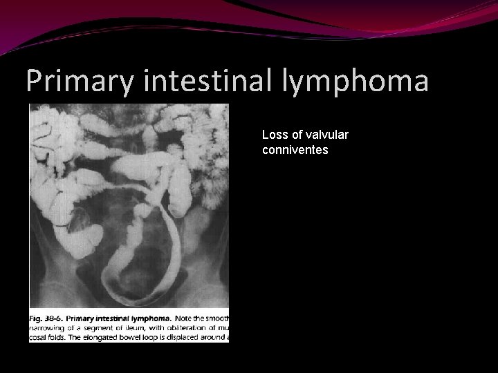 Primary intestinal lymphoma Loss of valvular conniventes 