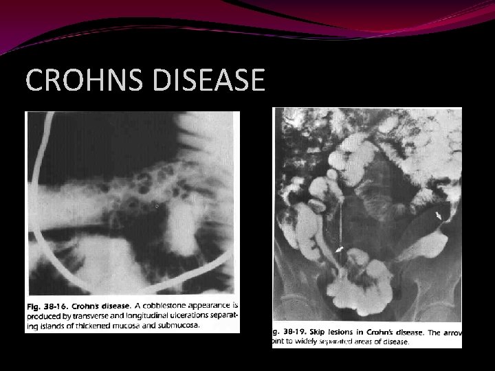 CROHNS DISEASE 