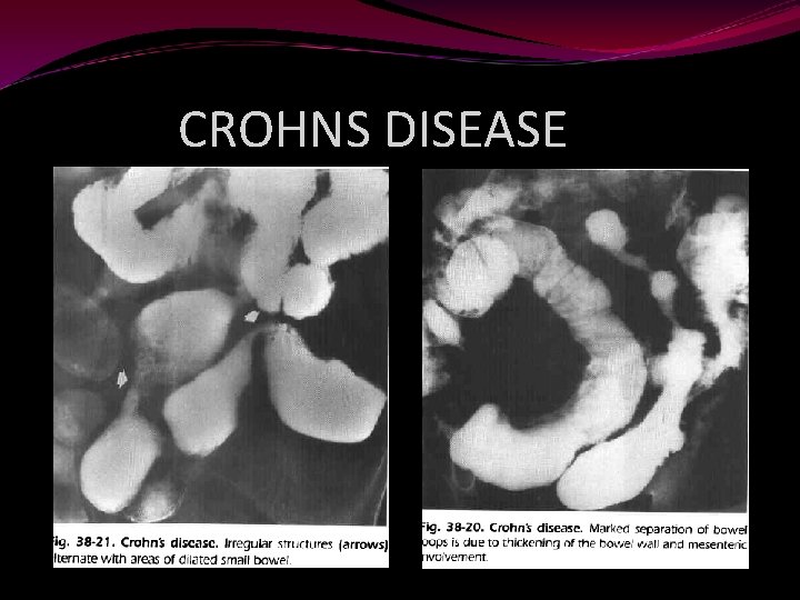 CROHNS DISEASE 