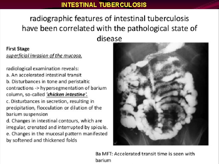 INTESTINAL TUBERCULOSIS 