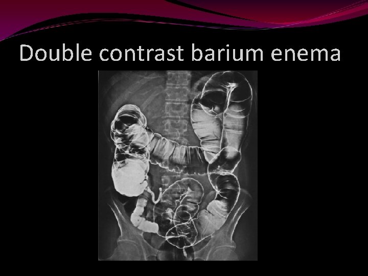Double contrast barium enema 