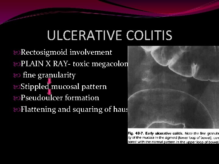 ULCERATIVE COLITIS Rectosigmoid involvement PLAIN X RAY- toxic megacolon/free gas fine granularity Stippled mucosal