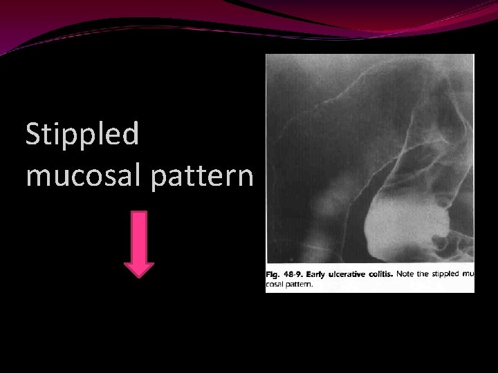 Stippled mucosal pattern 