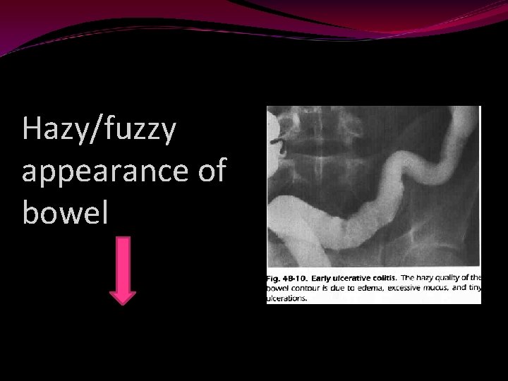 Hazy/fuzzy appearance of bowel 