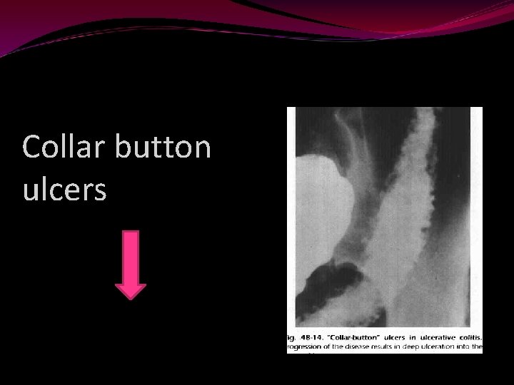 Collar button ulcers 