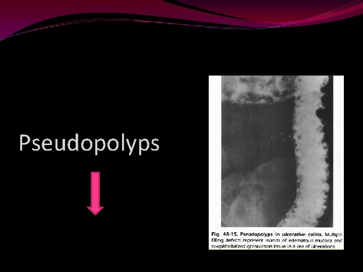 Pseudopolyps 