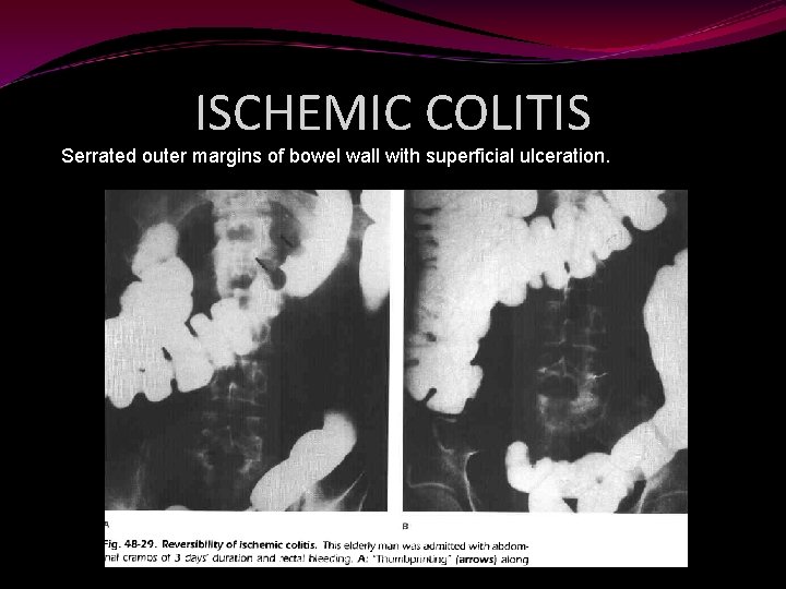 ISCHEMIC COLITIS Serrated outer margins of bowel wall with superficial ulceration. 