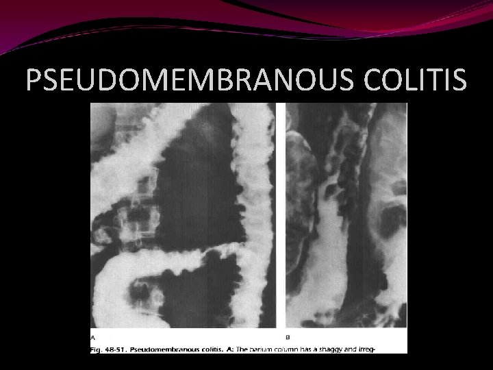 PSEUDOMEMBRANOUS COLITIS 