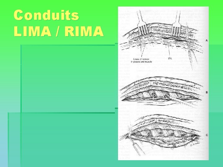 Conduits LIMA / RIMA 