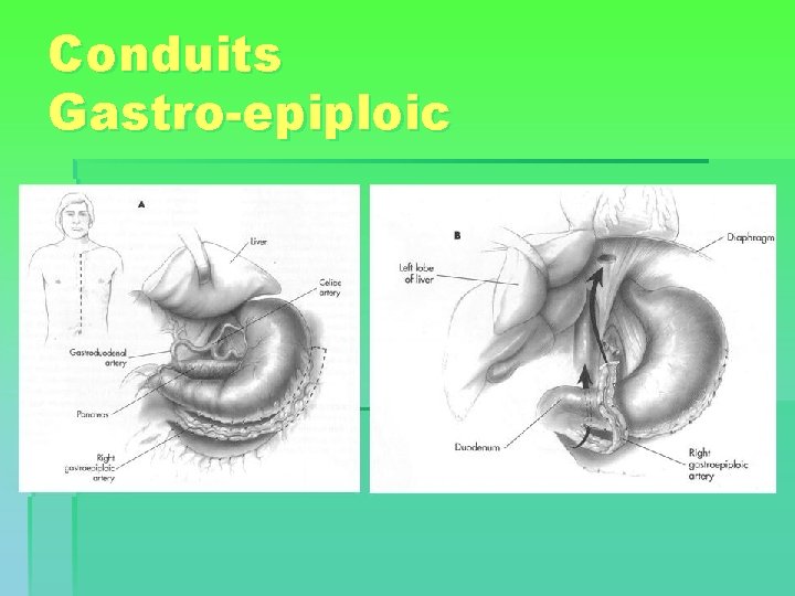 Conduits Gastro-epiploic 