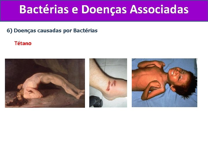 Bactérias e Doenças Associadas 6) Doenças causadas por Bactérias Tétano 