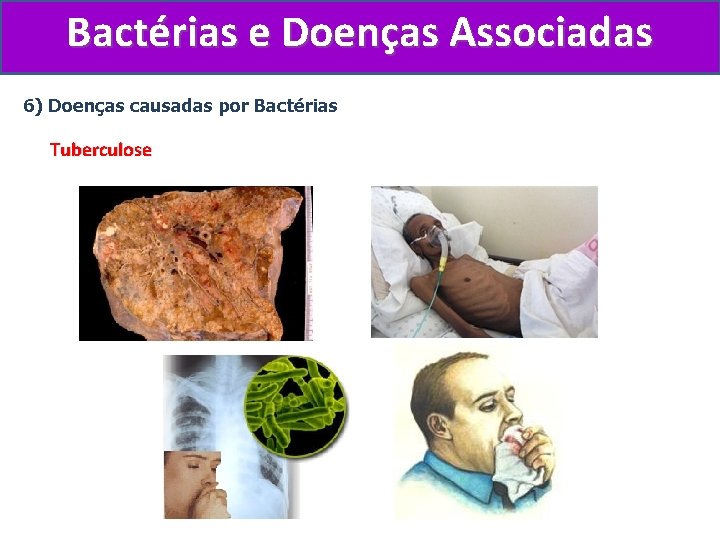 Bactérias e Doenças Associadas 6) Doenças causadas por Bactérias Tuberculose 