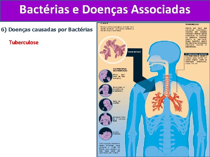 Bactérias e Doenças Associadas 6) Doenças causadas por Bactérias Tuberculose 