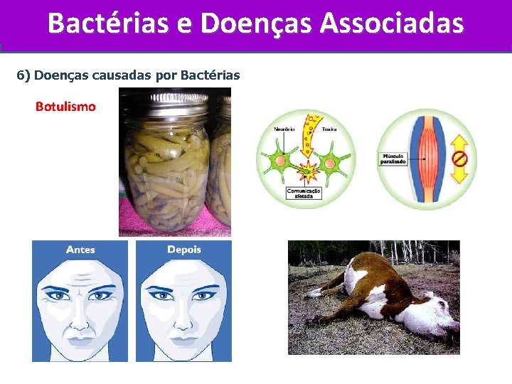 Bactérias e Doenças Associadas 6) Doenças causadas por Bactérias Botulismo 