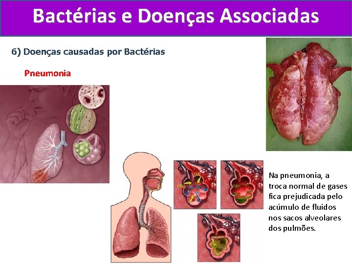 Bactérias e Doenças Associadas 6) Doenças causadas por Bactérias Pneumonia Na pneumonia, a troca