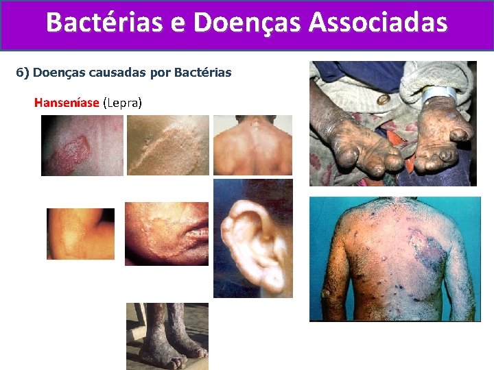 Bactérias e Doenças Associadas 6) Doenças causadas por Bactérias Hanseníase (Lepra) 