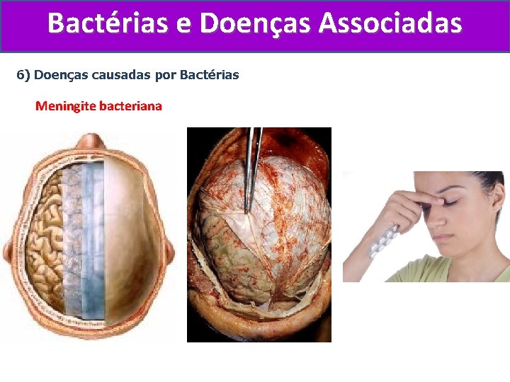 Bactérias e Doenças Associadas 6) Doenças causadas por Bactérias Meningite bacteriana 