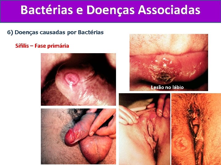 Bactérias e Doenças Associadas 6) Doenças causadas por Bactérias Sífilis – Fase primária Lesão