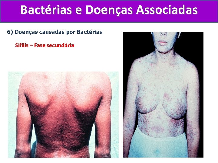 Bactérias e Doenças Associadas 6) Doenças causadas por Bactérias Sífilis – Fase secundária 