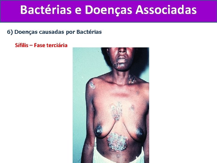 Bactérias e Doenças Associadas 6) Doenças causadas por Bactérias Sífilis – Fase terciária 