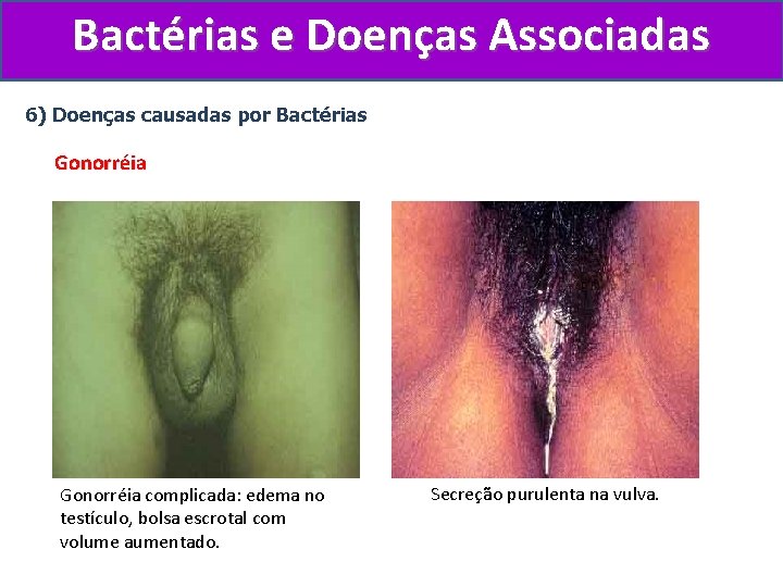 Bactérias e Doenças Associadas 6) Doenças causadas por Bactérias Gonorréia complicada: edema no testículo,