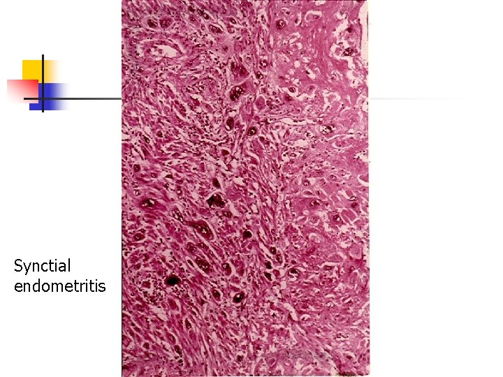 Synctial endometritis 