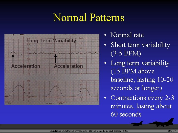 Normal Patterns • Normal rate • Short term variability (3 -5 BPM) • Long