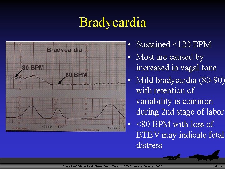 Bradycardia • Sustained <120 BPM • Most are caused by increased in vagal tone