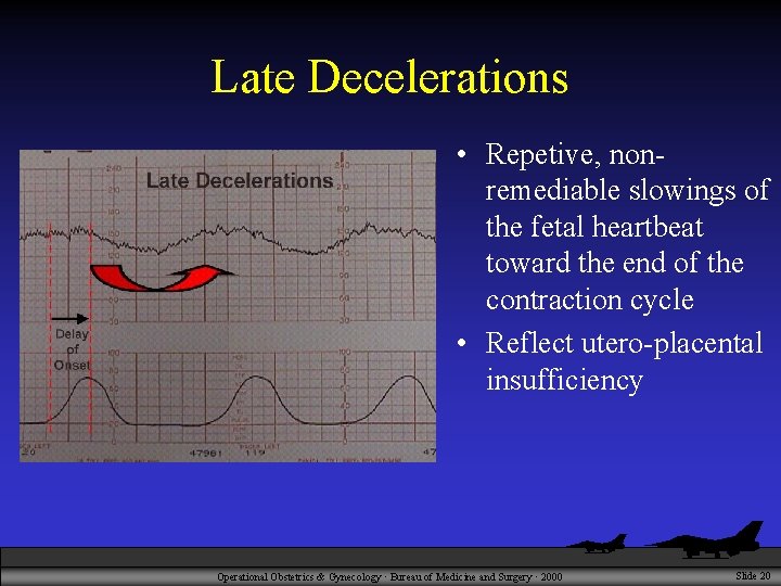 Late Decelerations • Repetive, nonremediable slowings of the fetal heartbeat toward the end of