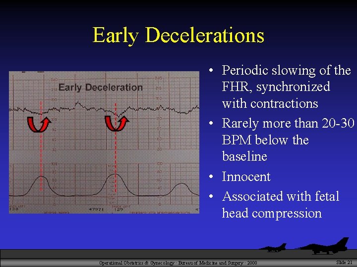 Early Decelerations • Periodic slowing of the FHR, synchronized with contractions • Rarely more