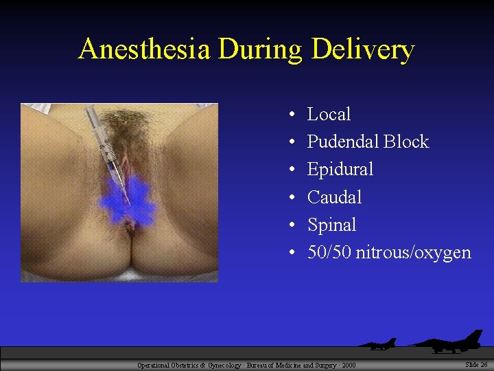 Anesthesia During Delivery • • • Local Pudendal Block Epidural Caudal Spinal 50/50 nitrous/oxygen