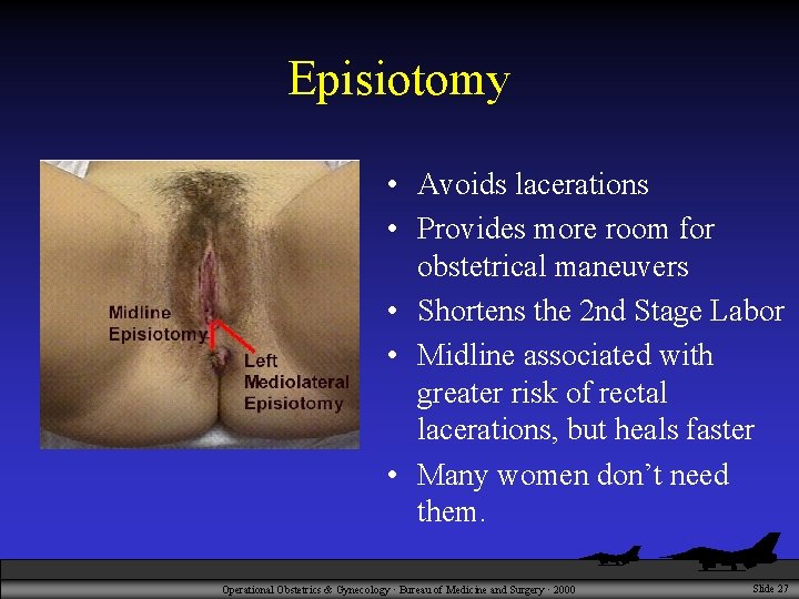 Episiotomy • Avoids lacerations • Provides more room for obstetrical maneuvers • Shortens the