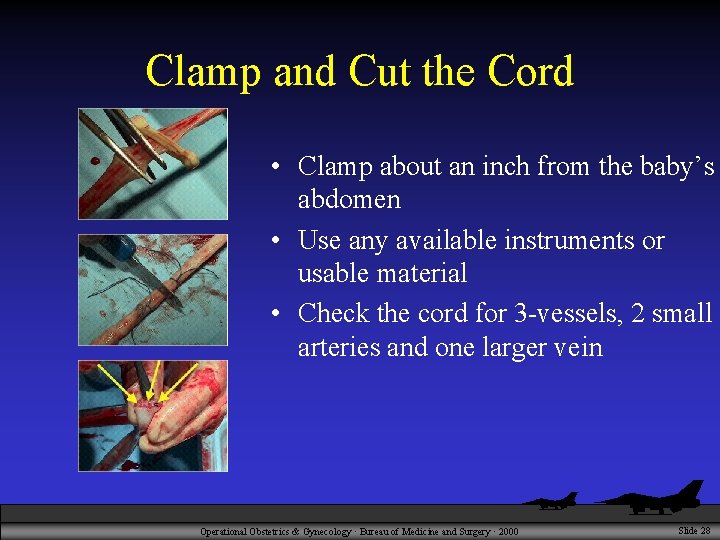 Clamp and Cut the Cord • Clamp about an inch from the baby’s abdomen