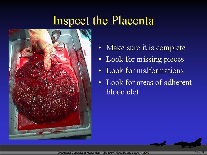 Inspect the Placenta • • Make sure it is complete Look for missing pieces