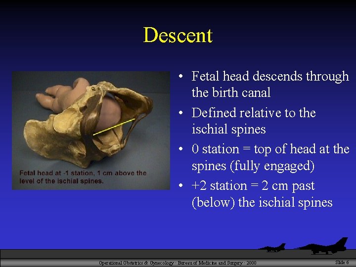 Descent • Fetal head descends through the birth canal • Defined relative to the