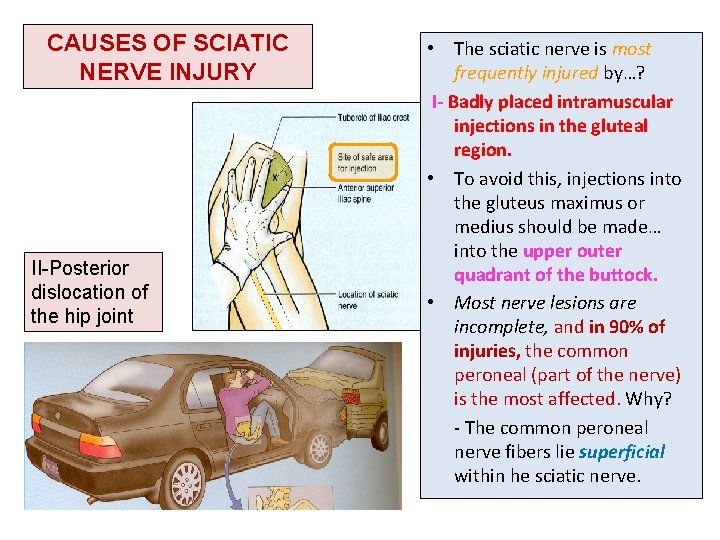 CAUSES OF SCIATIC NERVE INJURY II-Posterior dislocation of the hip joint • The sciatic