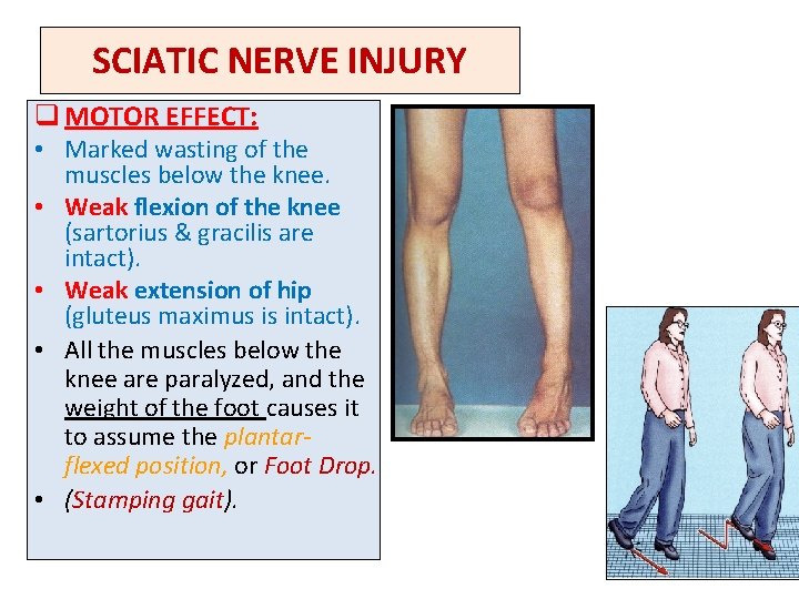 SCIATIC NERVE INJURY q MOTOR EFFECT: • Marked wasting of the muscles below the